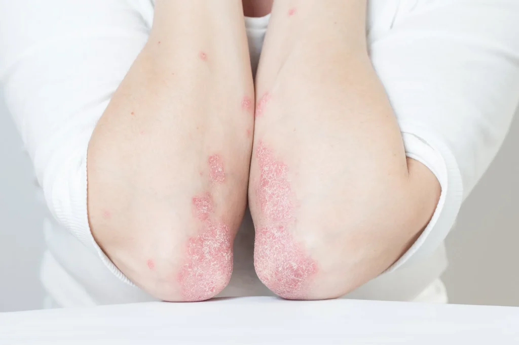 Psoriasis