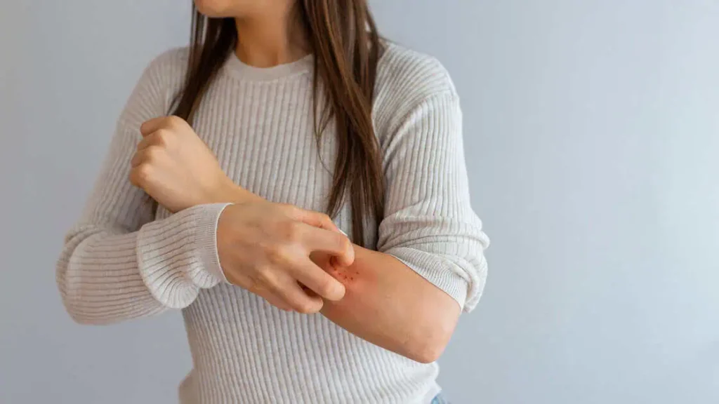 Psoriasis by Omega Health Clinics in Modesto, CA