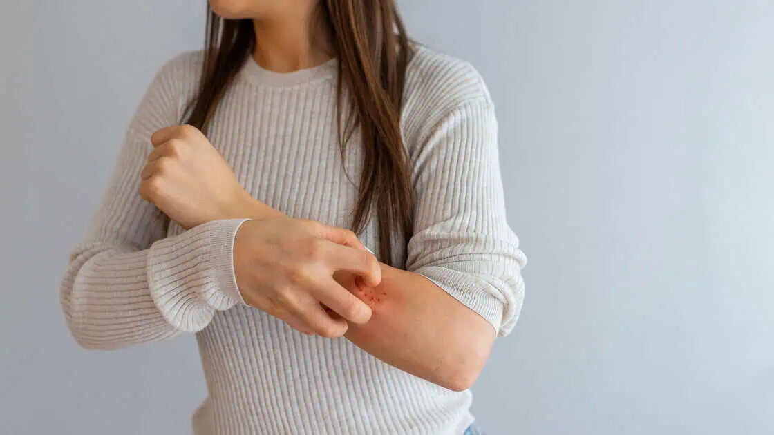Psoriasis by Omega Health Clinics in Modesto, CA