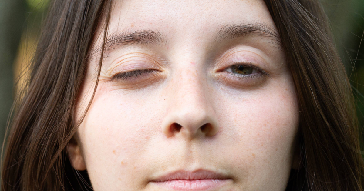 Close-up of a young woman with one drooping eyelid, a possible symptom of Myasthenia Gravis, outdoors with a neutral expression in Modesto, CA