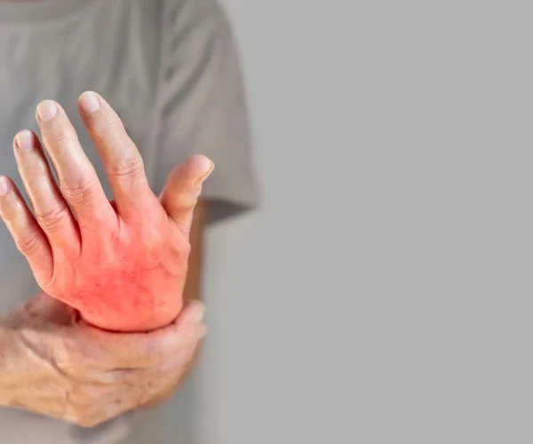 Rheumatoid Arthritis