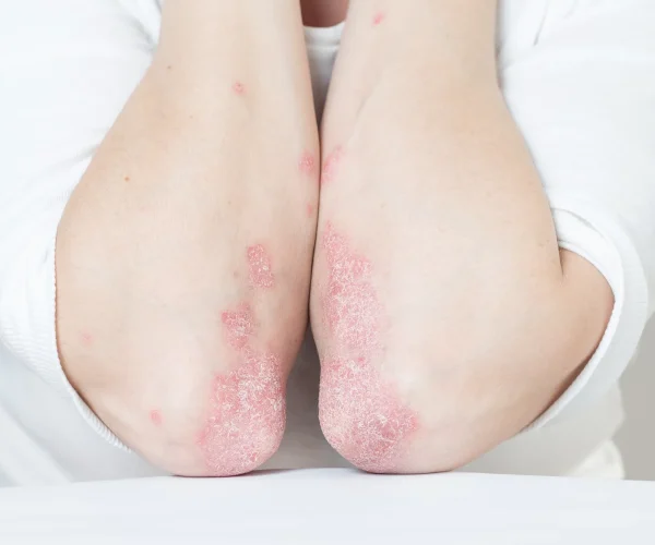 Psoriasis