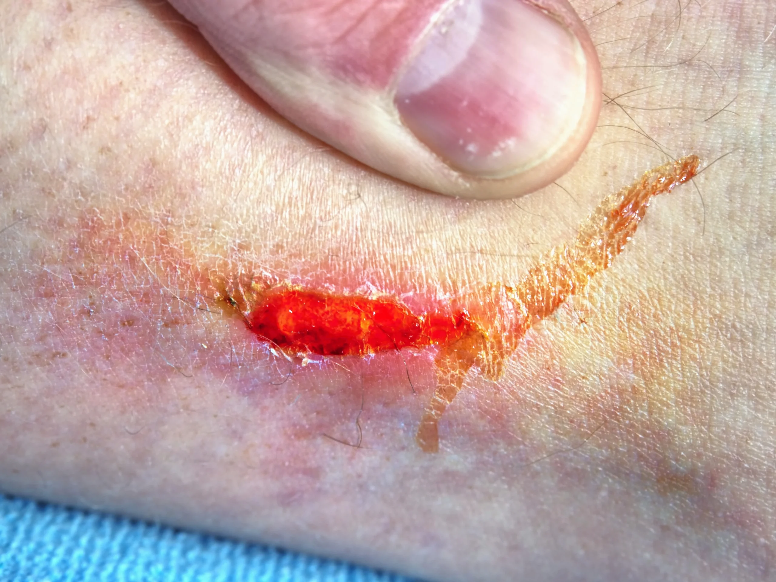 wound care in Modesto, CA by Omega Health Clinics