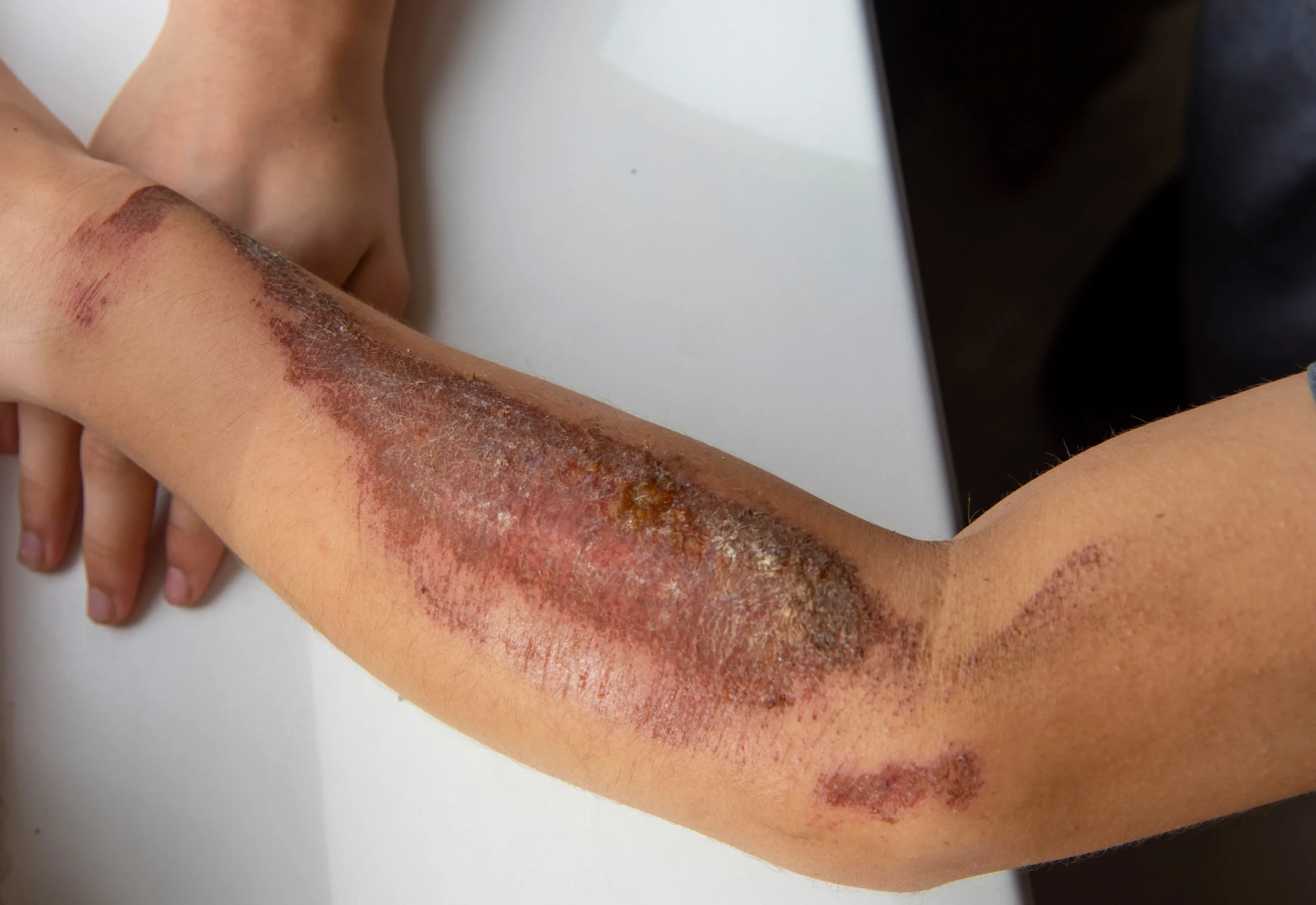 Burn wound care in Modesto, CA by Omega Health Clinics