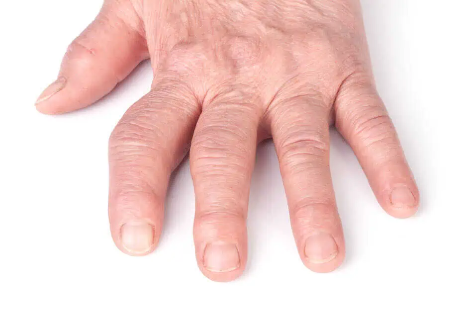 Polyarteritis Treatment in Modesto, CA by Omega Health Clinics
