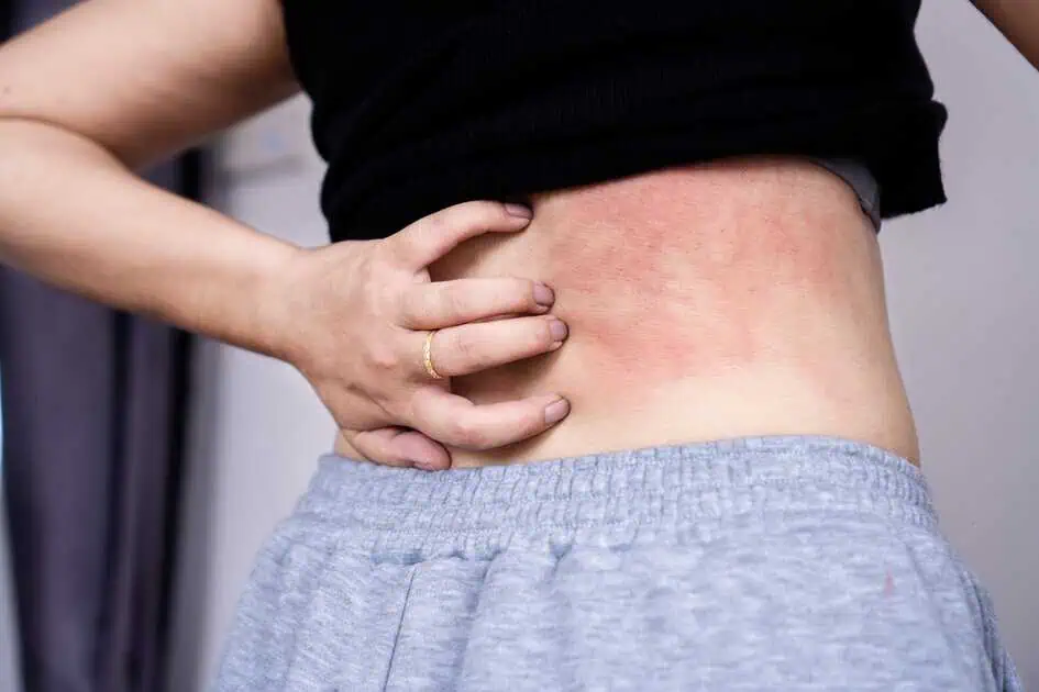 Urticaria Treatment in Modesto CA by Omega Health Clinics